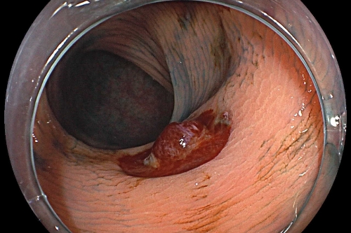 大腸ポリープ切除術（コールドスネアポリペクトミー）